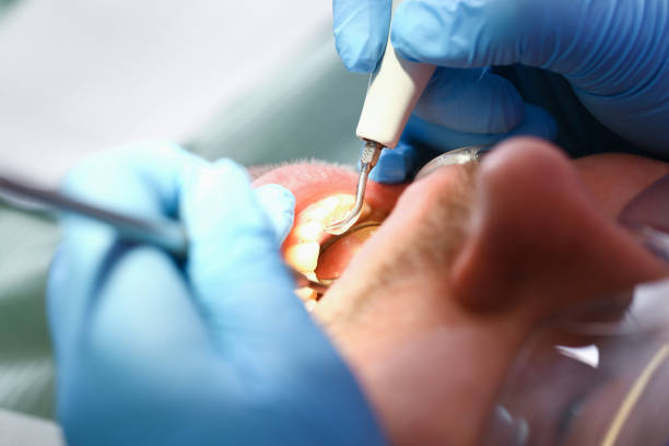Best Emergency Dentist for Lost Fillings or Crowns in Ivyland, PA
